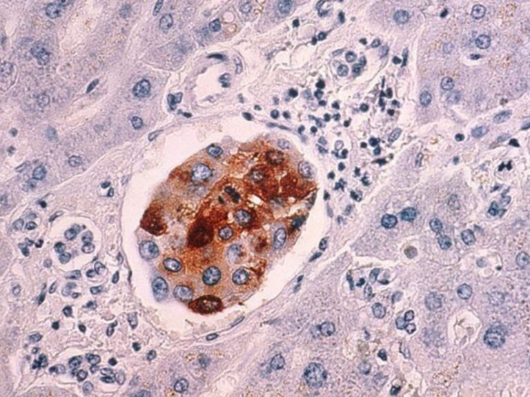 Imagen de microscopio enseñando un BRCA1/2 germinal.