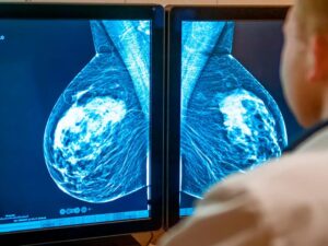 Ecografia enseñando el Cáncer de mama triple negativo.