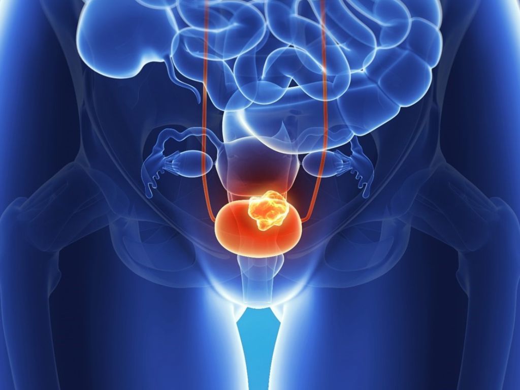 Ilustración de Enfortumab vedotina y NECTIN4 en cáncer urotelial.